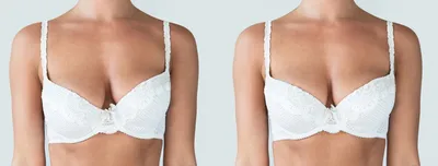 Асимметрия после маммопластики: почему возникает и как избежать деформации  после пластики груди