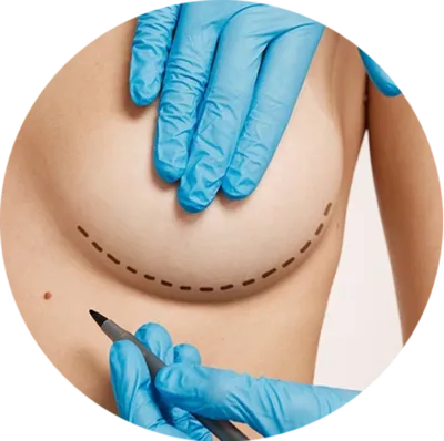 Дабл бабл после маммопластики (увеличения груди) | Александр Маркушин  пластический хирург