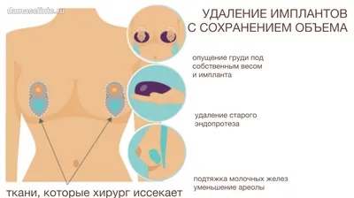 Импланты грудные — цены в Минске
