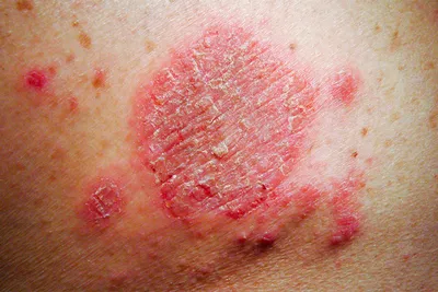 Сфера применения] При дерматите (аллергический дерматит, нейродермит,  солнечный дерматит), экземе, отрубевидном лишае, (потовых пятнах)… |  Instagram