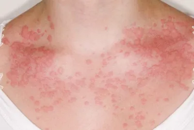 Аллергия на солнце (фотодерматит): симптомы, причины, лечение | EVA Blog
