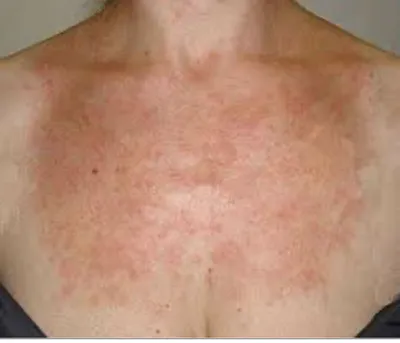 Аллергия на солнце: как выглядит, как проявляется, лечение | РБК Стиль