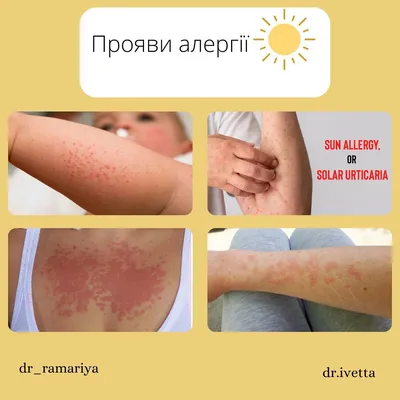 Аллергия на солнце - врач рассказала о лечении солнечной крапивницы -  Апостроф