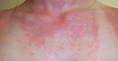 Аллергия на солнце или реакция иммунной системы? — Медицинский центр  Integro Черкассы