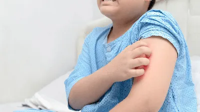 Аллергическая крапивница - симптомы, лечение, признаки заболевания у детей  и взрослых