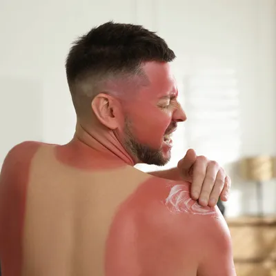 Первая помощь и лечение обожженной на солнце кожи