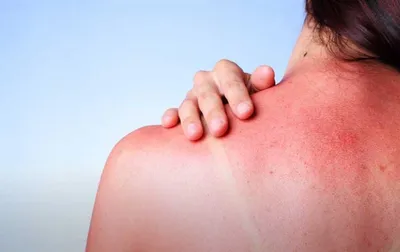 Оказание первой помощи при ожогах кожи: что делать, признаки и степень  поражения