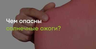 Что делать, если обгорел на солнце? Как быстро избавиться от солнечных  ожогов?