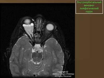 Vascular Anomalies Center