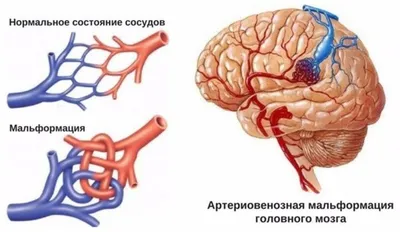 Возможности реконструктивной пластической хирургии в лечении капилл