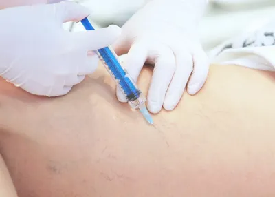 Лазерное лечение венозной мальформации на лице в клинике «Delete» - клиника  лазерной косметологии в Москве