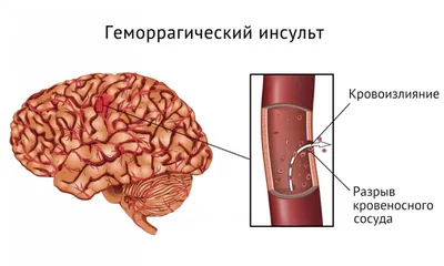 Сай Ігор Богданович on Instagram: \"📍Простая сосудистая мальформация кожи  лица. HPWS (гипертрофия тканей и ангиоматозные разрастания) Наиболее часто  задаваемый вопрс: 🤔 \"Зачем...?\" 🤔 Зачем лечить...? 🤔 Зачем мучить  ребёнка...? 🥺 Подрастёт, сам