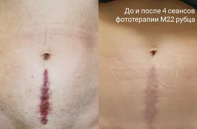 Лазерное удаление сосудов в Москве — Damas Medical Center