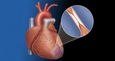 Как проверить сосуды сердца? | Доктор Ленар Кашапов | Дзен