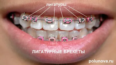 Чем отличаются лигатурные брекеты от безлигатурных | Ортодонт-центр  Ортодонтика, Москва