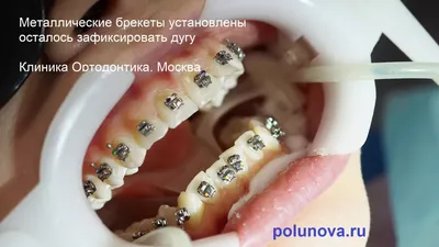 В каких случаях самолигирующие брекеты лучше ставить – клиника Ортодонтика,  Москва