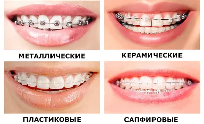 Виды брекетов в ортодонтии