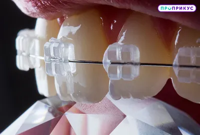 Металлические брекеты - Dental Practice