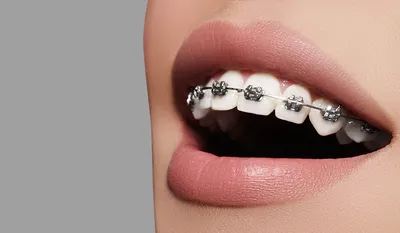 Установка брекетов для выравнивания зубов в рассрочку - стоматология  Симфония улыбки