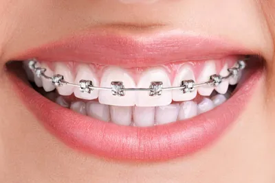Irena Dent - В современной стоматологии проблему неправильного прикуса  решают брекеты. В стоматологической клинике Irena Dent предлагается  установка съемных пластинок и несъемных брекет-систем, применяющиеся для  лечения взрослых пациентов при уже ...