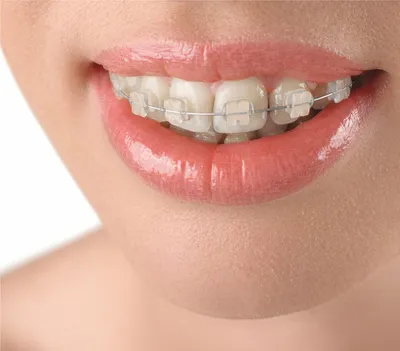 Эффективность лечения металлическими брекетами – зуботехническая  лаборатория «АстэраЛаб»