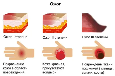 Ожог — Википедия