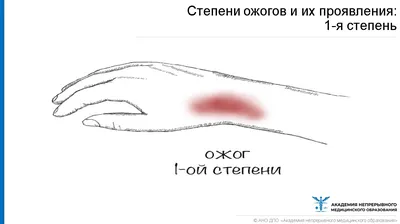 Первая помощь при ожогах, что делать, чем помазать