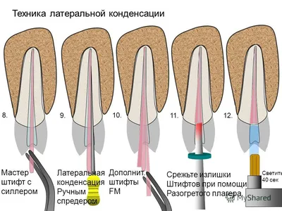 Спредер 15-25 | Купить стоматологические товары недорого в  интернет-магазине Dental First