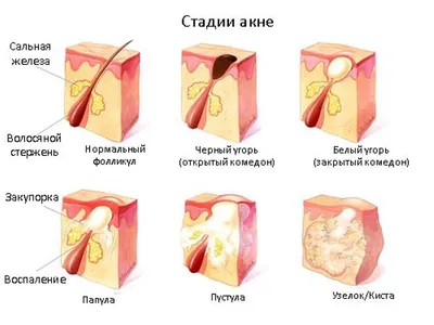 Акне,что это такое? | DorMedicina | Дзен