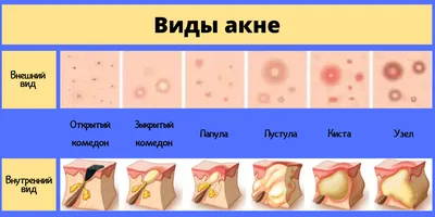 Лечение АКНЕ (угревая сыпь). Лечение конглобатного акне в СПб