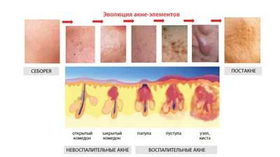 Лечение акне (угрей) в Киеве | Brenner Clinic