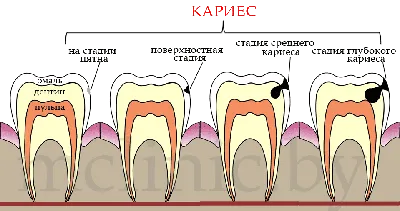 Стадии кариеса - методы лечения кариеса