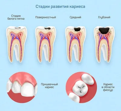 Начальный и поверхностный кариес: симптомы и методы лечения зубов