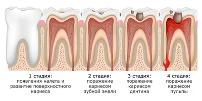 Чтобы зубы не болели: профилактика кариеса у взрослых и детей | ДокторСлон  | Эксперт в уходе за полостью рта | Дзен