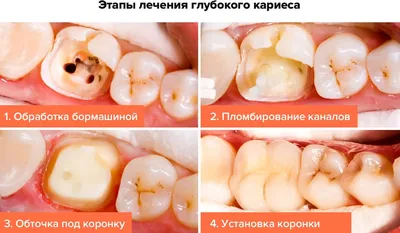 Кариес корня зуба- симптомы, причины, методы лечения кариеса зуба