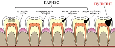 Современные и результативные методики лечения кариеса