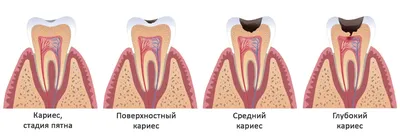 Лечение кариеса в Перми без боли | Безболезненное лечение кариеса в  стоматологии | ООО «Стоматологическая клиника «Венеция», г. Пермь