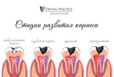 Средний кариес — симптомы, диагностика, лечение