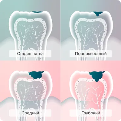 Кариес в стадии пятна