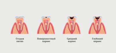 Стадии кариеса: симптомы, причины, методы диагностики | Стоматологическая  клиника «Ваш стоматолог»