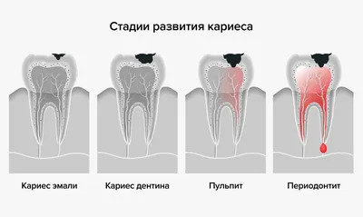 Поверхностный кариес [диагностика, лечение без боли и цена в Москве]