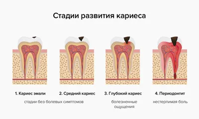 Лечение кариеса | Luxsmile