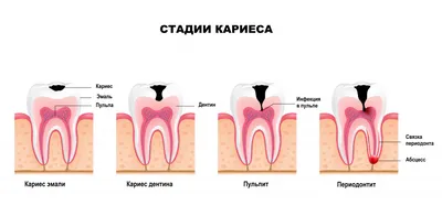 Лечение кариеса цены Москва Полянка Третьяковская стоматология