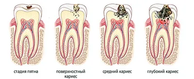 Кариес: причины, лечение, профилактика