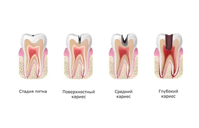 Стадии кариеса: лечение