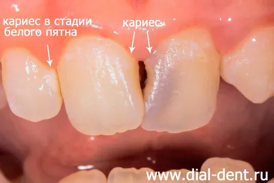 Лечение кариеса молочных зубов у детей в Томске