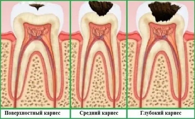 Лечение кариеса. Екатеринбург, Стоматологическая клиника Дента Ви