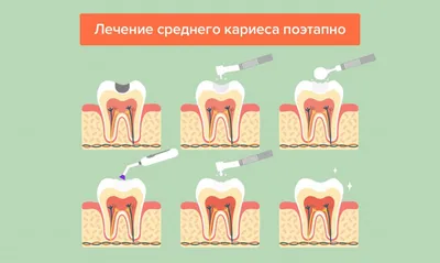 Лечение кариеса в Москве | Стоматология Denta