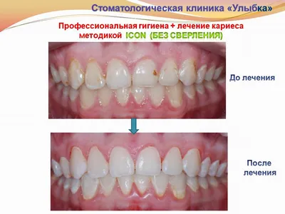 Возможно ли лечение кариеса без сверления зубов? | Мегастом - сеть клиник