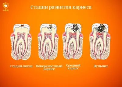 Лечение начальной стадии кариеса методикой Icon.